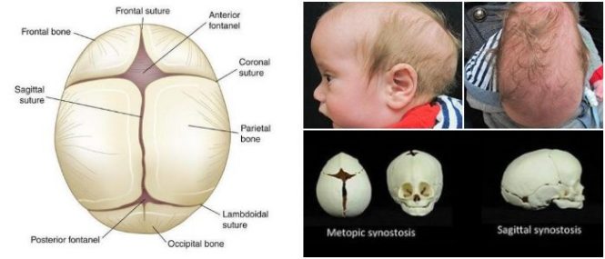 جراحی کرانیوسینوستوز craniosynostosis  در کودکان